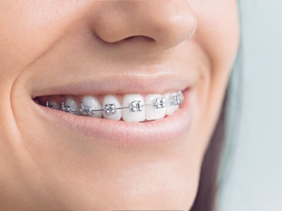 Poking Wire? Here are Some Pointers - Stone Oak Orthodontics