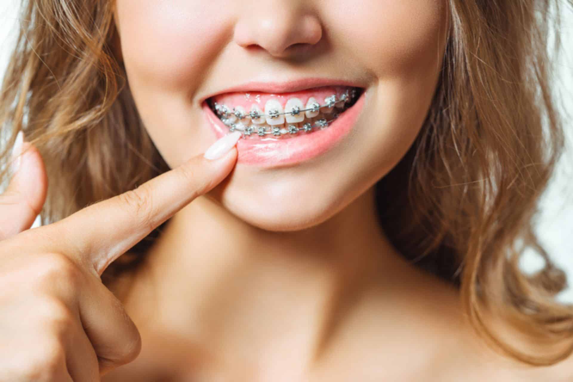 What Happens After Braces Come Off? Stone Oak Orthodontics in San Antonio, TX