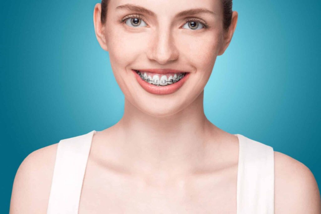 Do Braces Support Healthier Gums? Stone Oak Orthodontics in San Antonio, TX