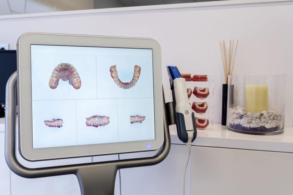 iTero digital impressions at Stone Oak Orthodontics Stone Oak Office and Dominion Office in San Antonio TX